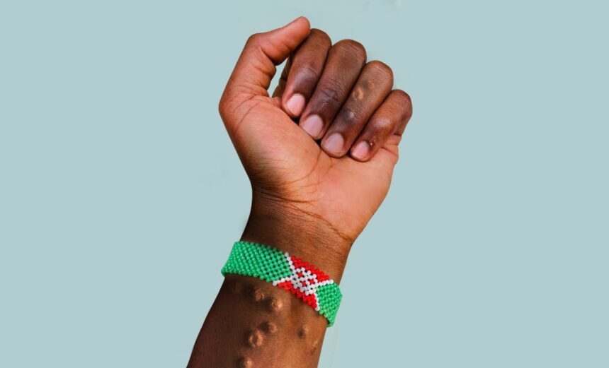Burundi’s Mpox Crisis A Growing Concern Across the Region